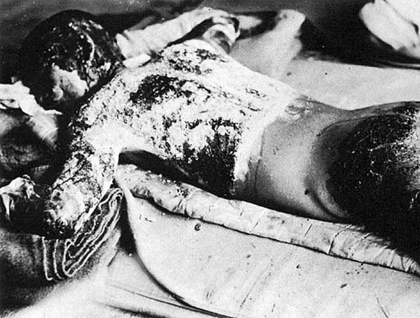 VICTIM OF ATOMIC BOMB - WIKIPEDIA